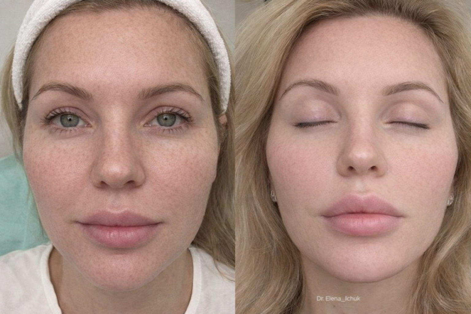 Эффект мезотерапии