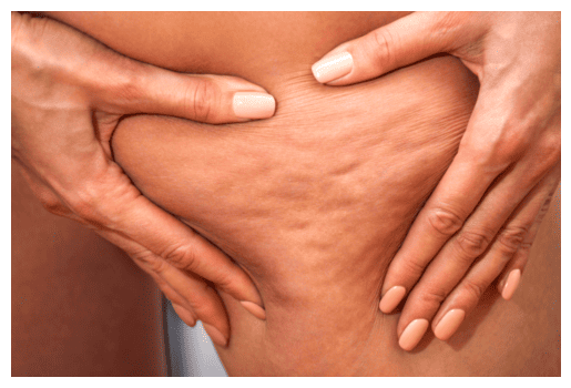 Подводный антицеллюлитный массаж